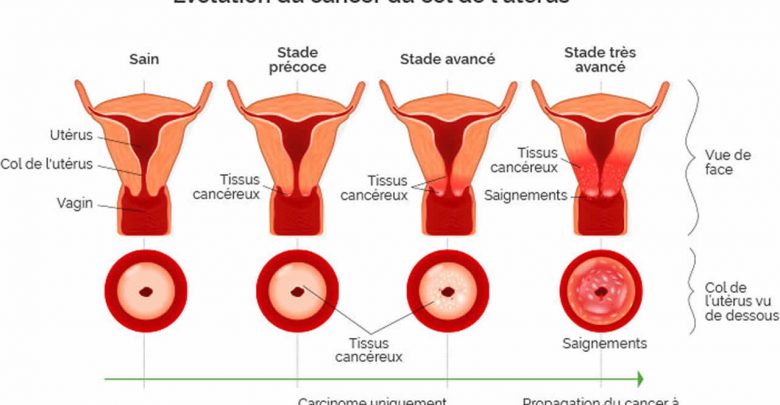 Cancer du col de l’utérus