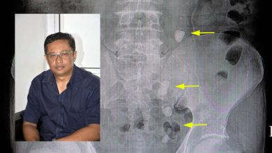 Photo of [Allô Docteur] Dr Mahendra Kumar Awotar : « Une personne peut développer jusqu’à 15 à 20 pierres »